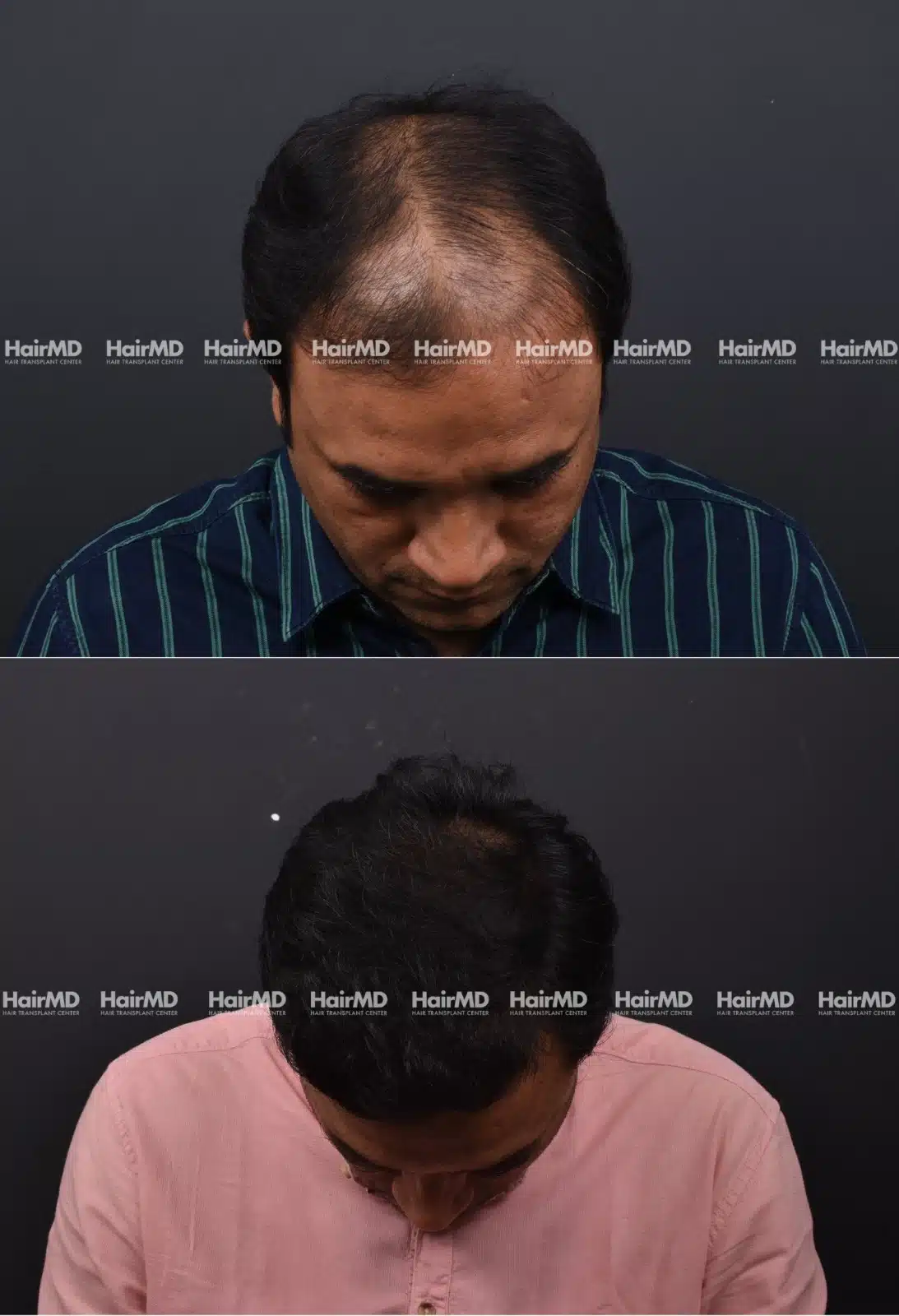 Hair Transplant