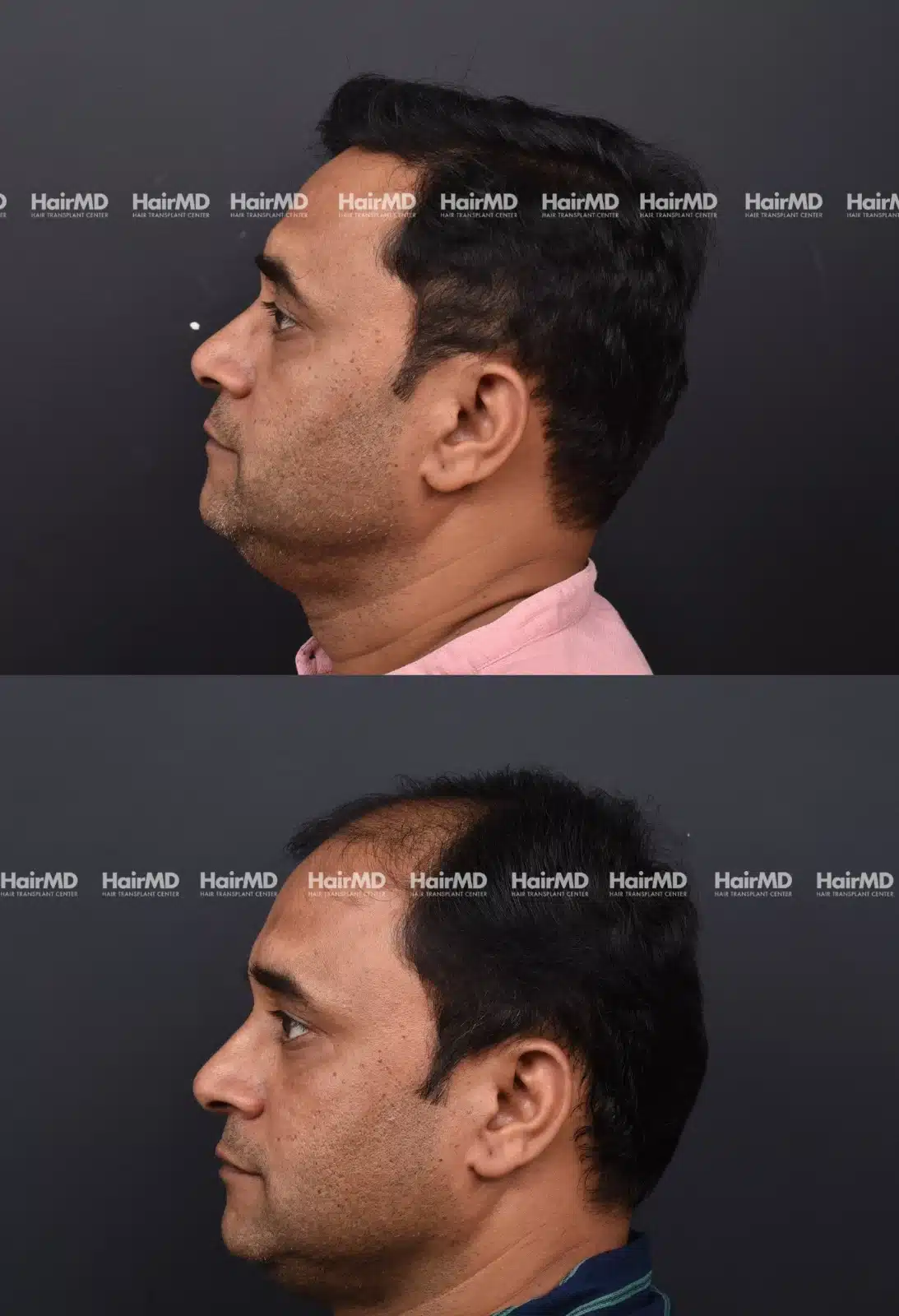 Hair Transplant