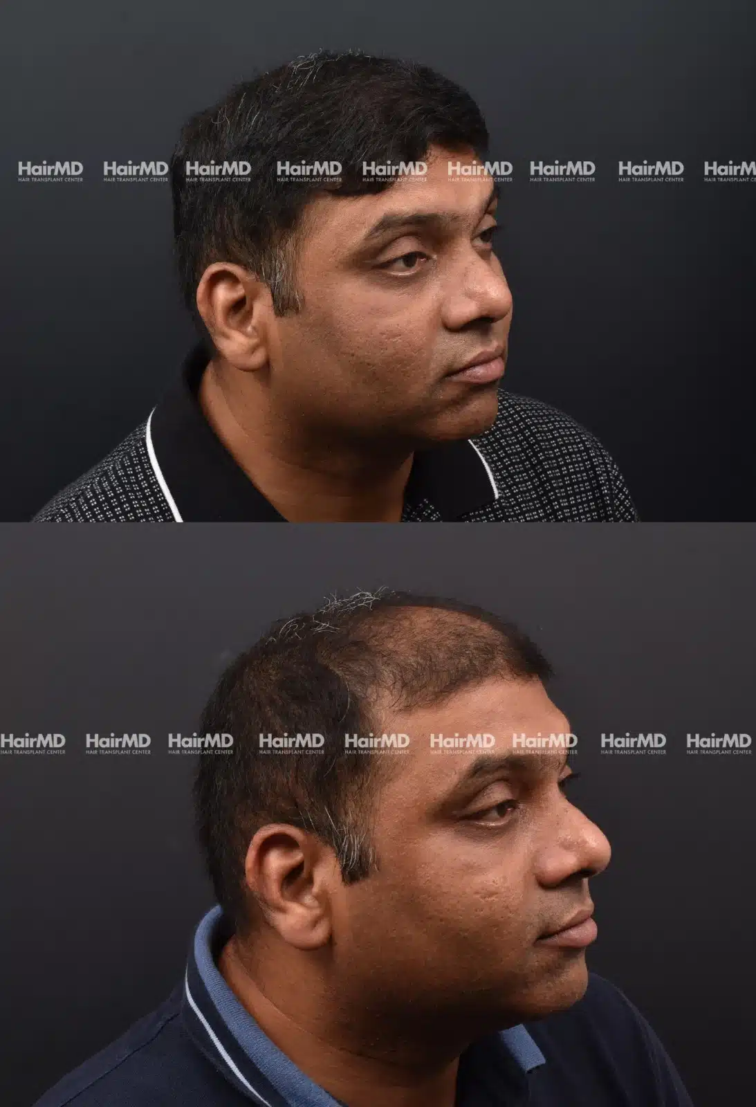 Hair Transplant
