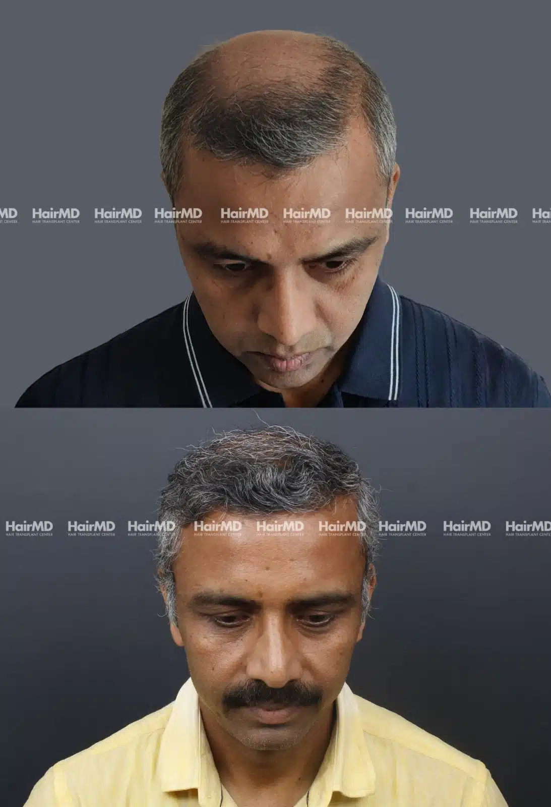 Hair Transplant