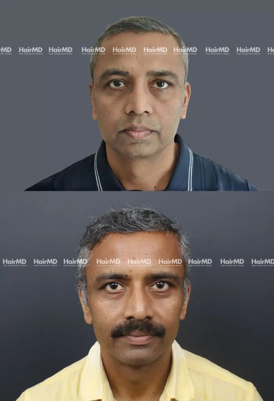 Hair Transplant