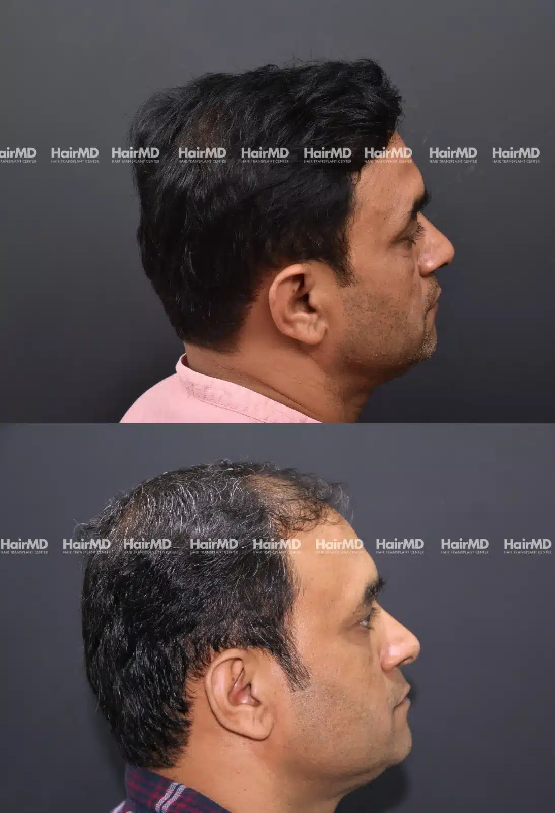 Hair Transplant
