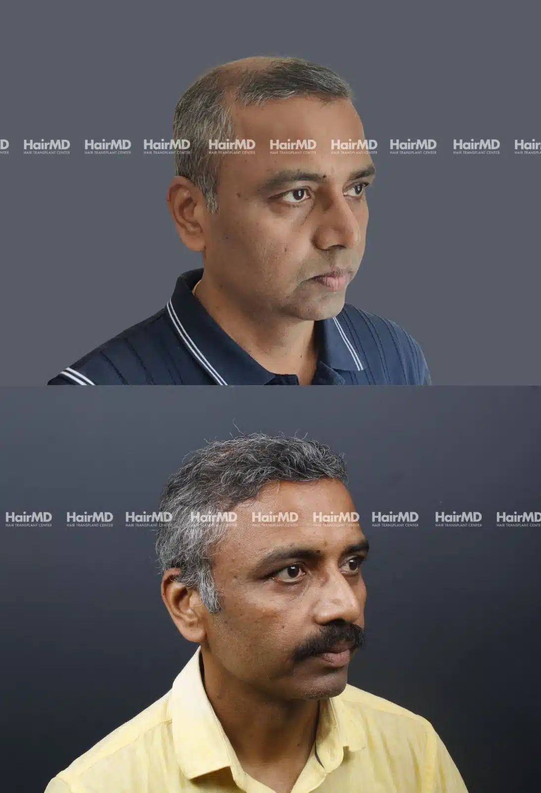 Hair Transplant