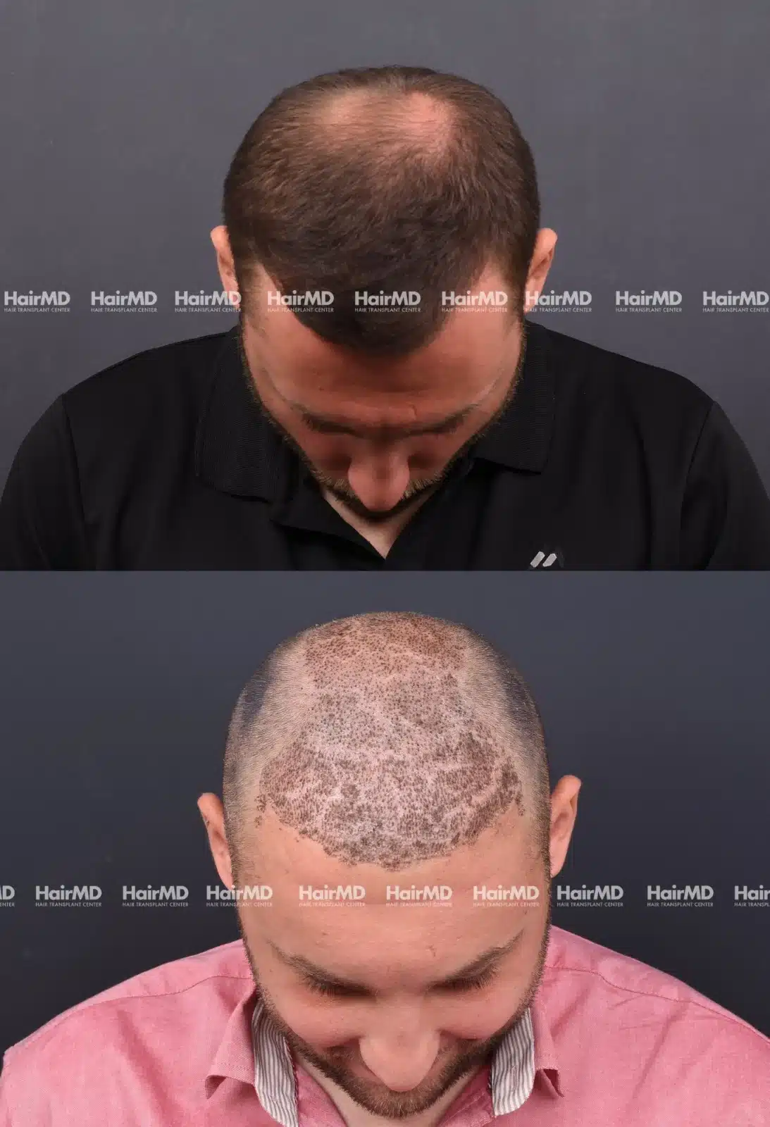 Hair Transplant