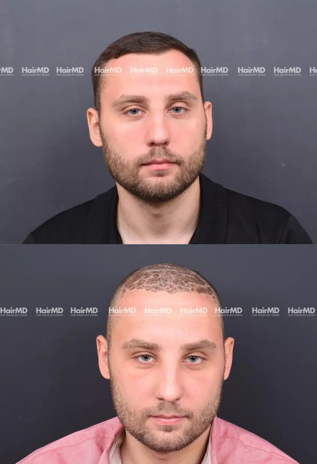 Hair Transplant
