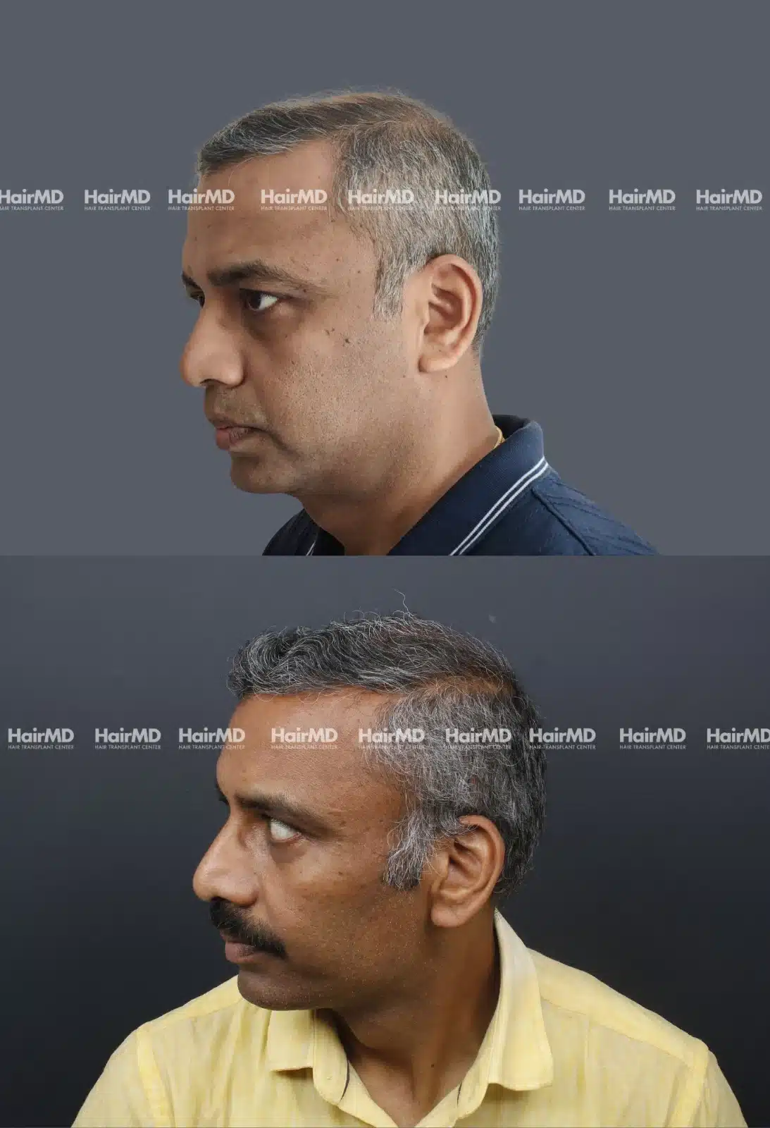Hair Transplant