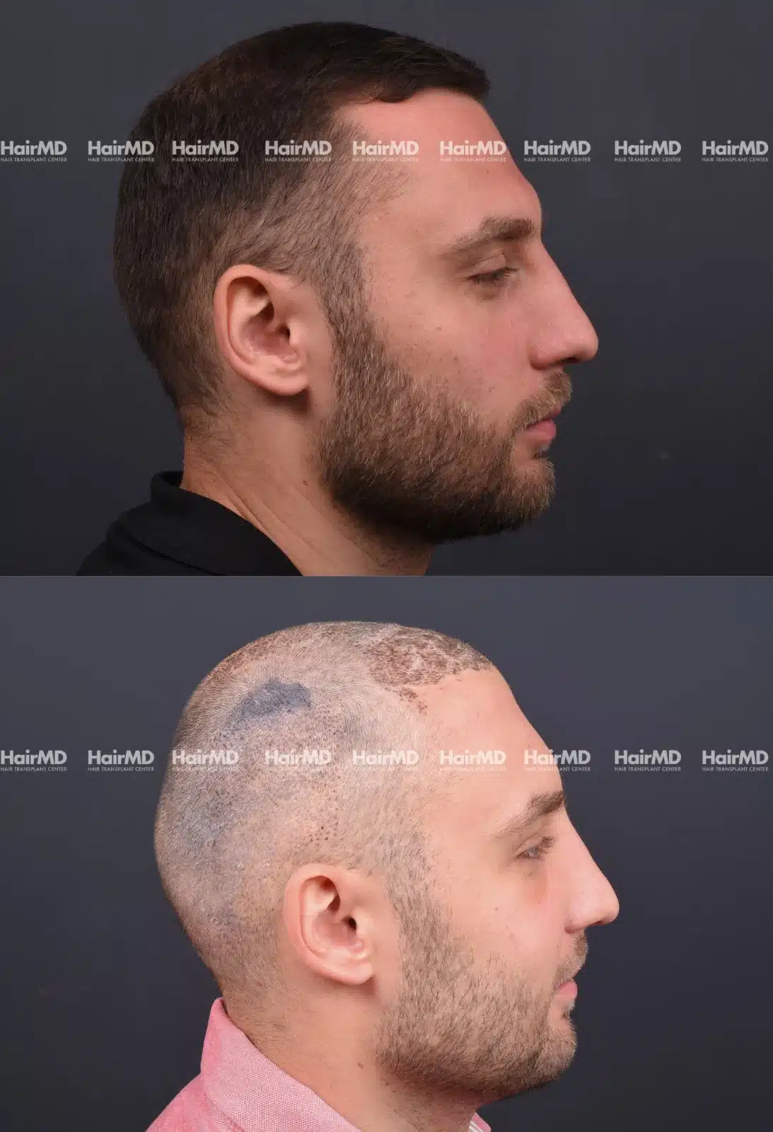 Hair Transplant