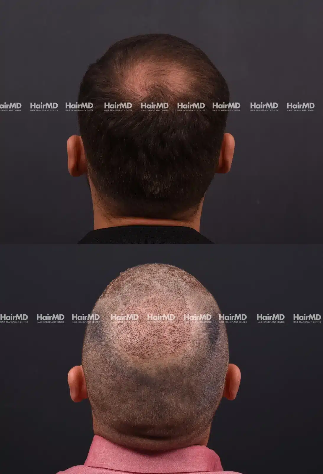 Hair Transplant